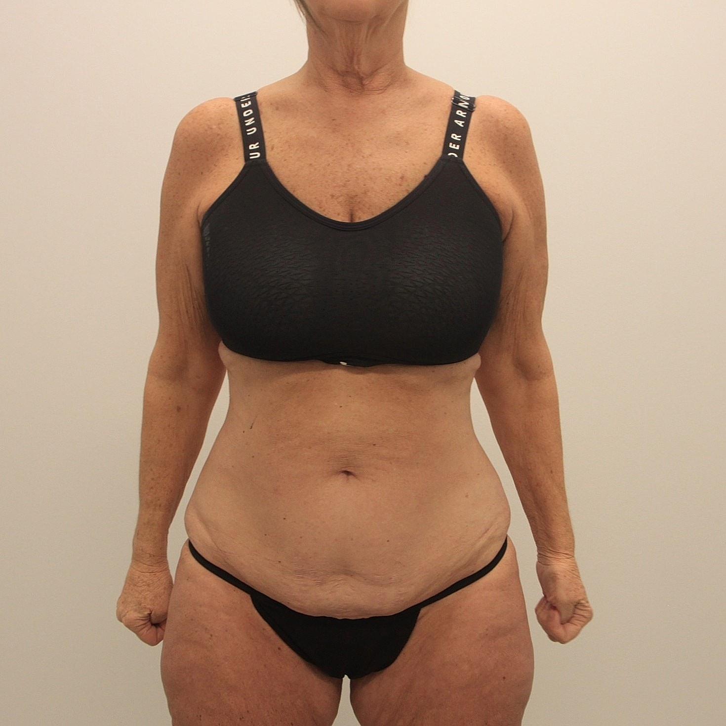 Tummy Tuck Before & After
