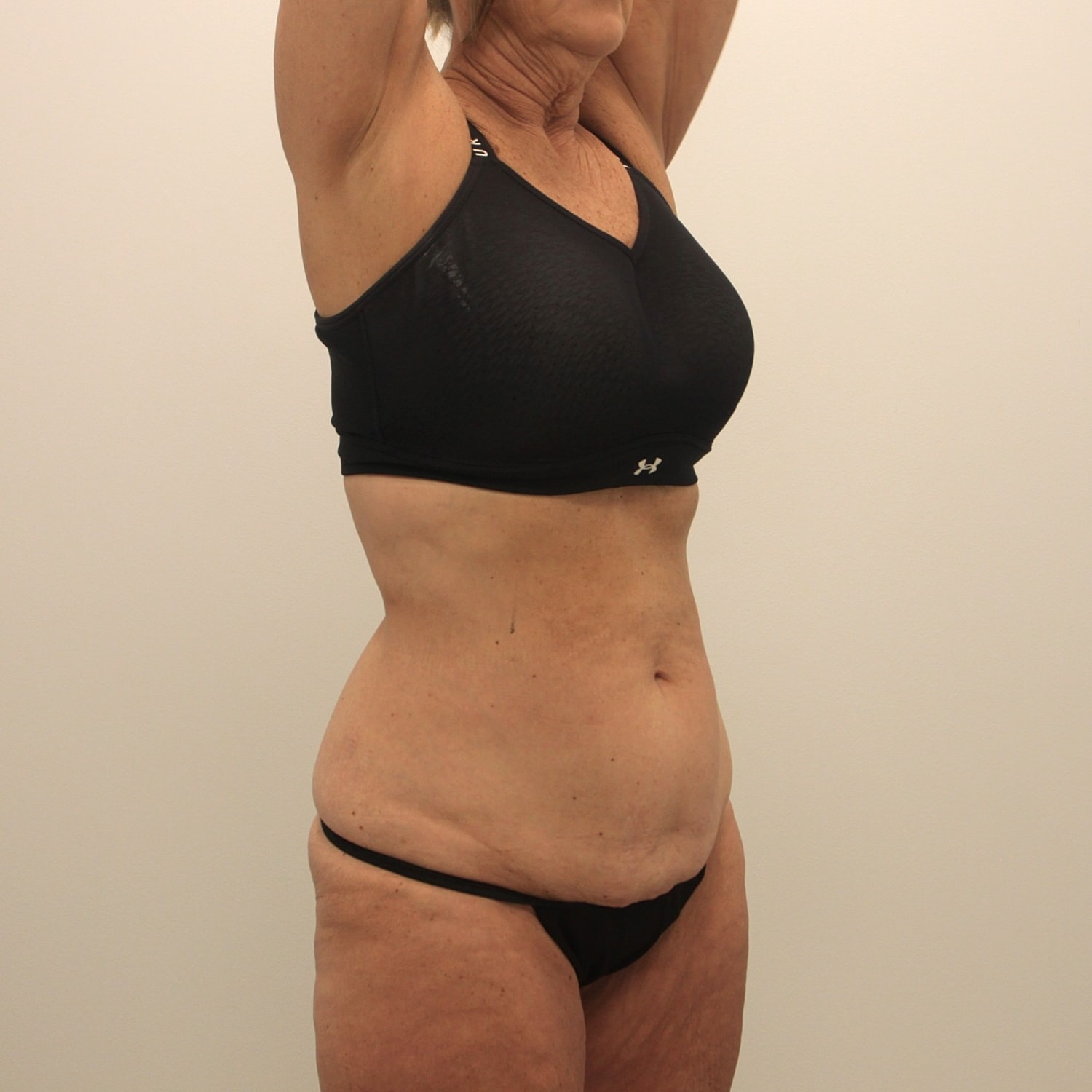 Tummy Tuck Before & After