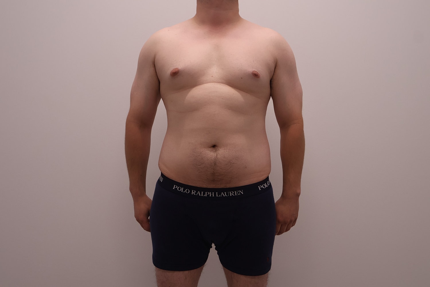 Male Body Contouring Before & After