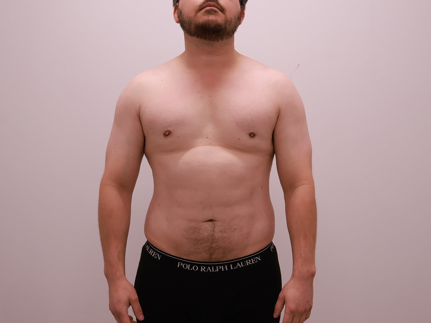 Male Body Contouring Before & After