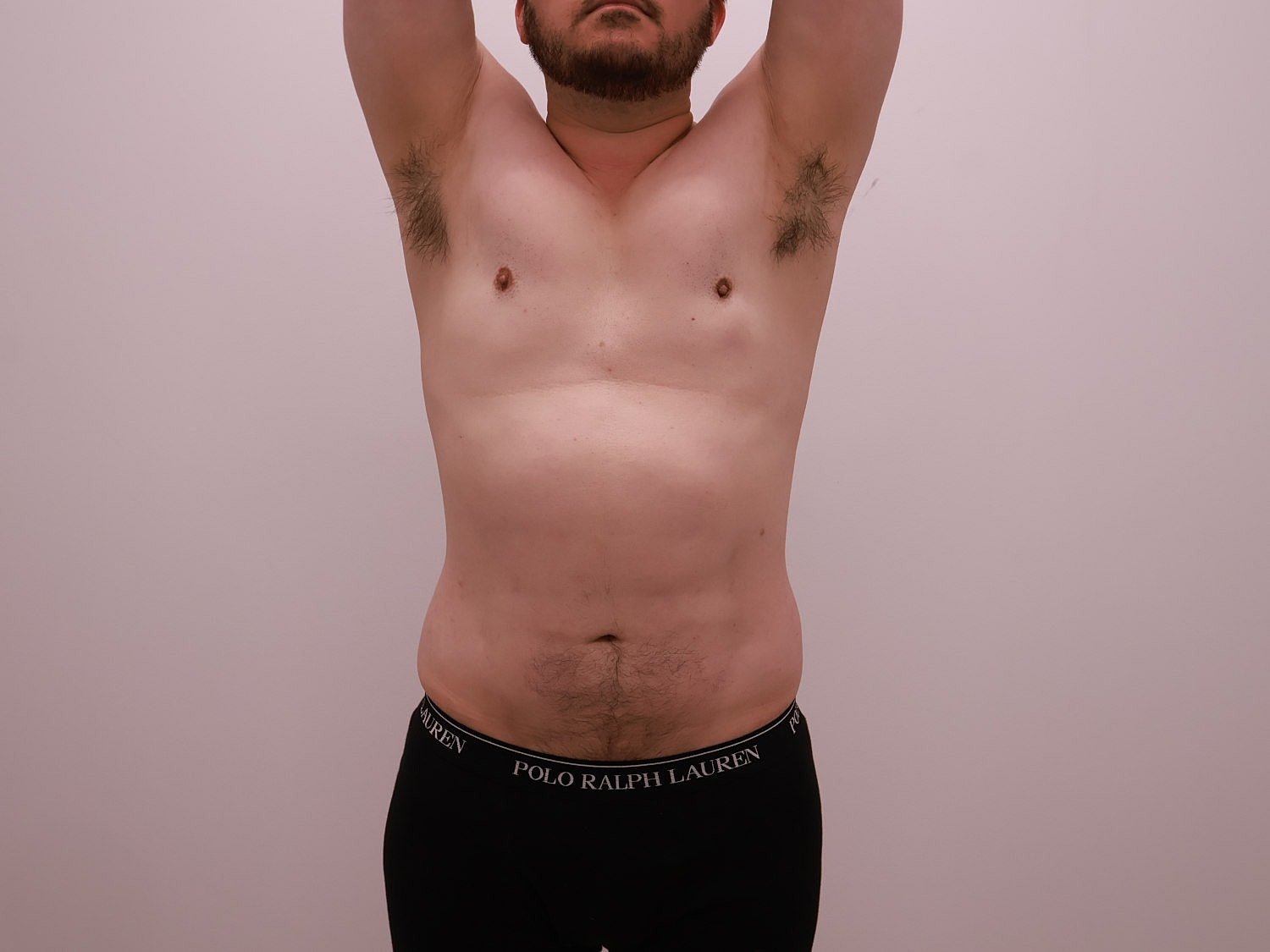 Male Body Contouring Before & After