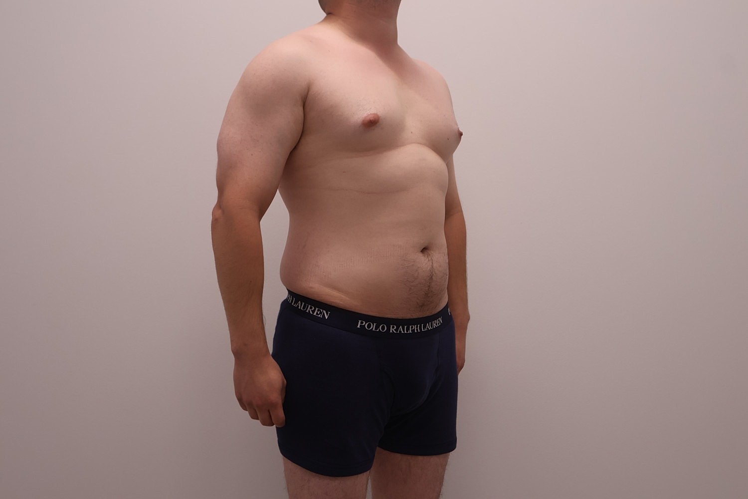 Male Body Contouring Before & After