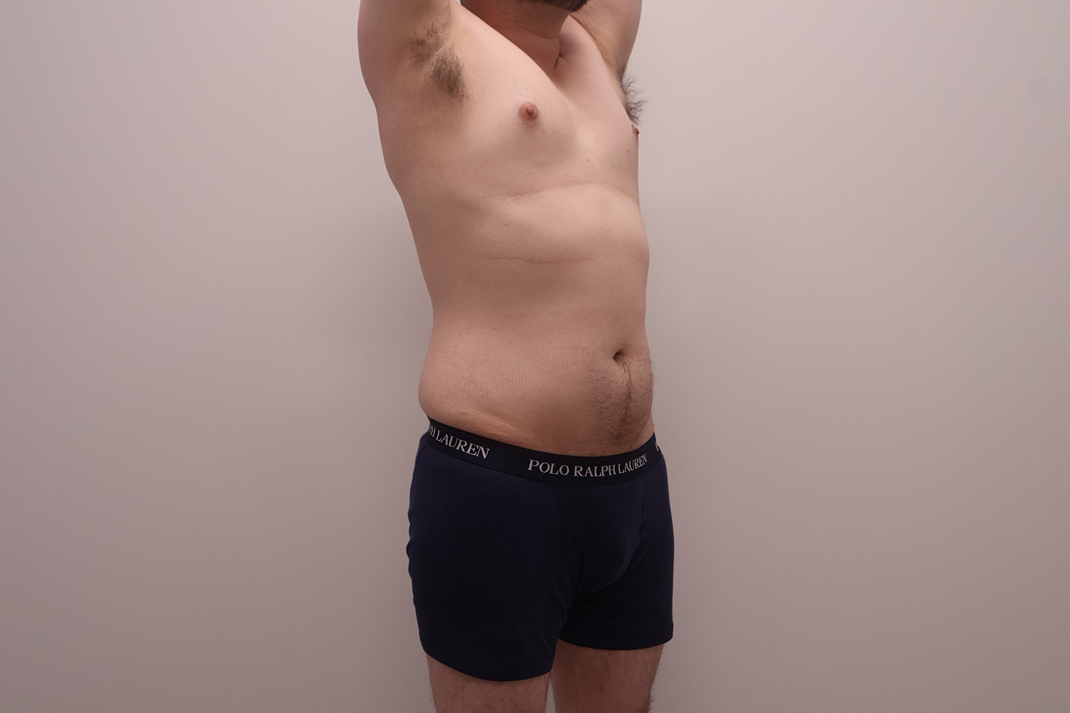 Male Body Contouring Before & After