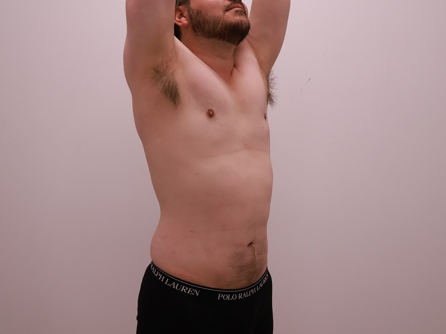 Male Body Contouring Before & After