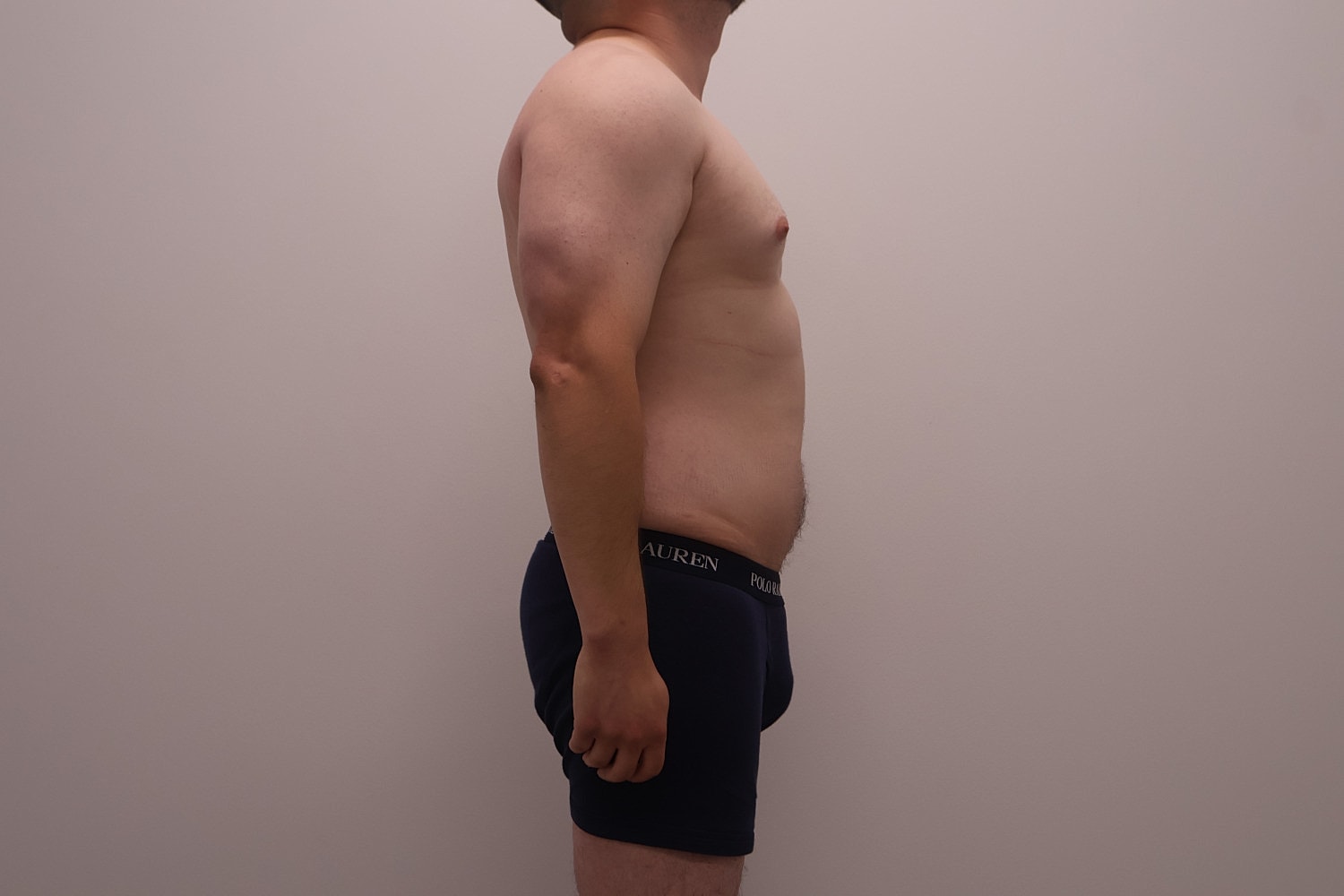 Male Body Contouring Before & After