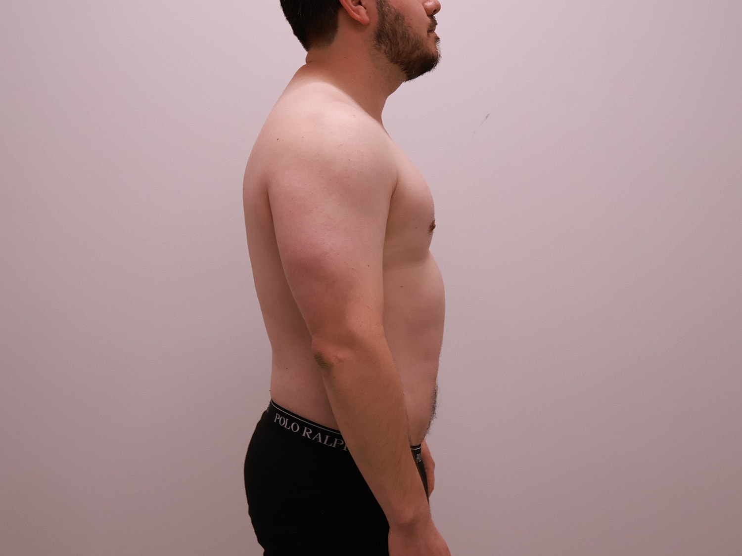 Male Body Contouring Before & After