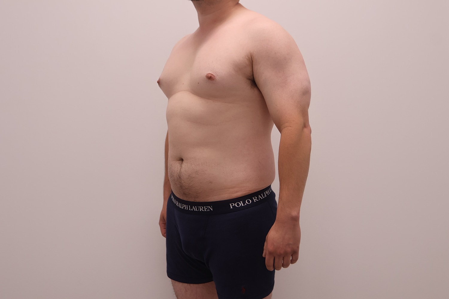 Male Body Contouring Before & After