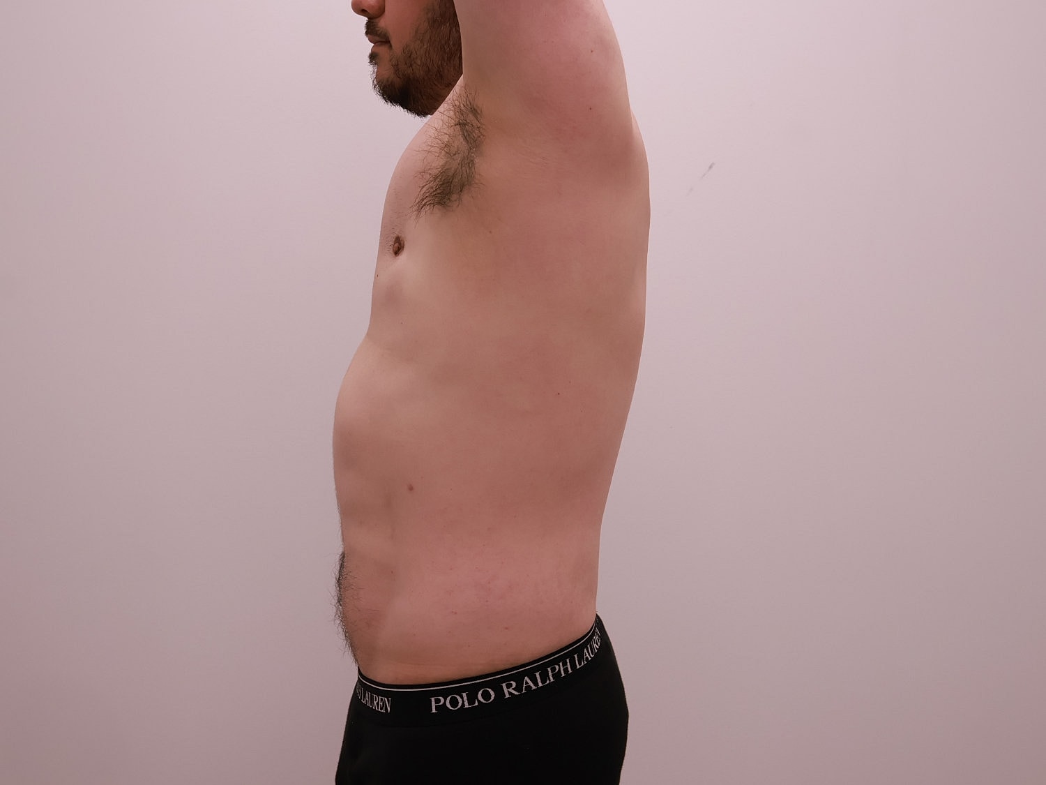 Male Body Contouring Before & After