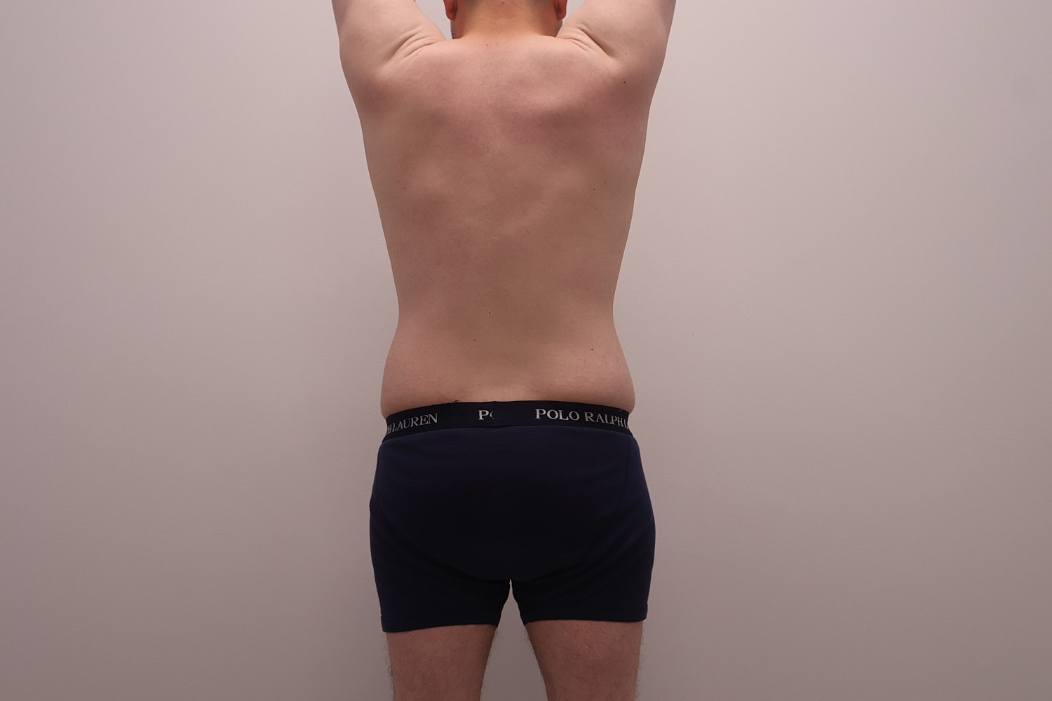 Male Body Contouring Before & After