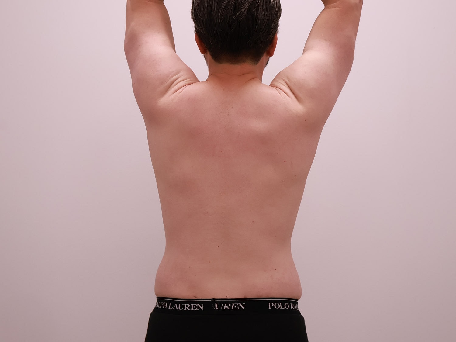 Male Body Contouring Before & After