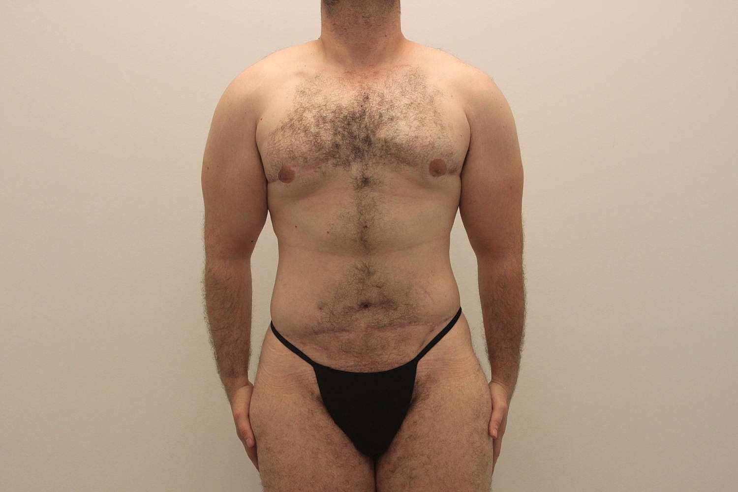 Male Body Contouring Before & After