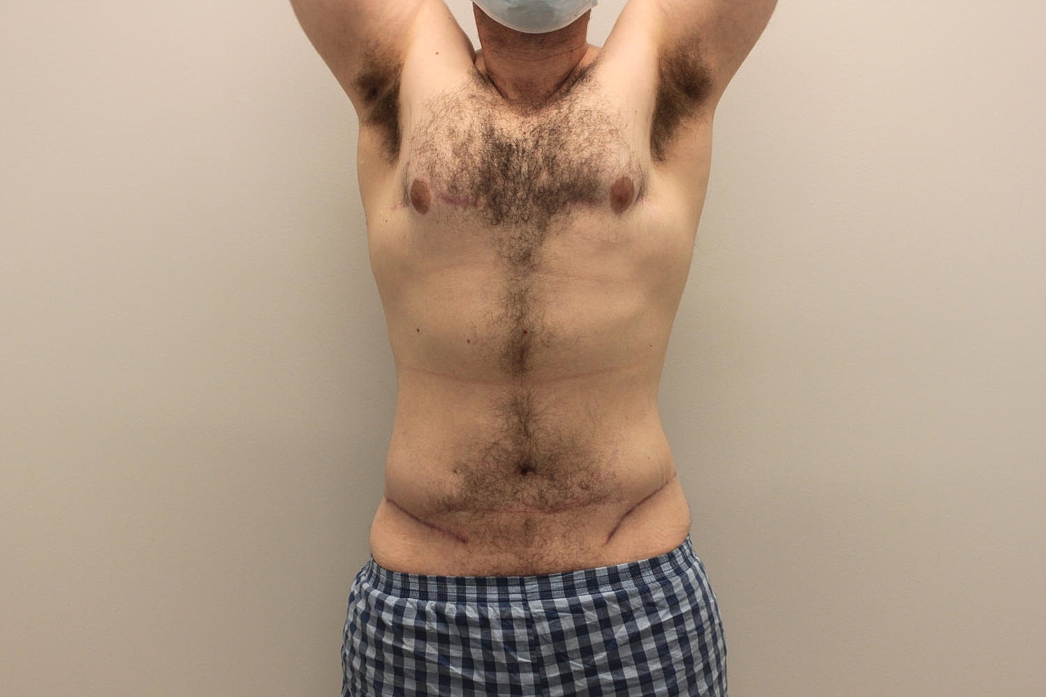 Male Body Contouring Before & After