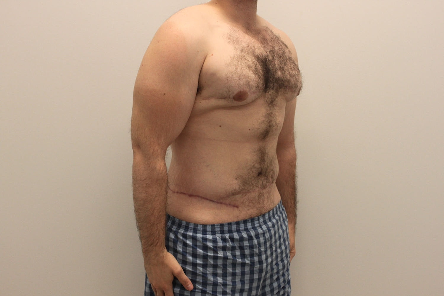 Male Body Contouring Before & After