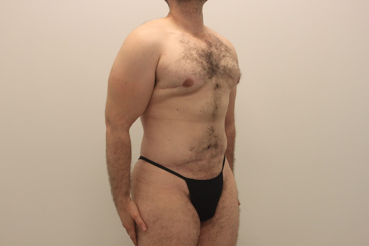 Male Body Contouring Before & After