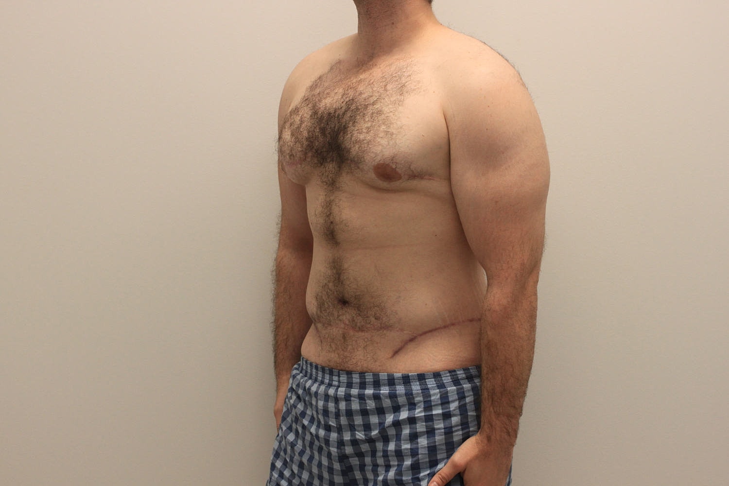 Male Body Contouring Before & After