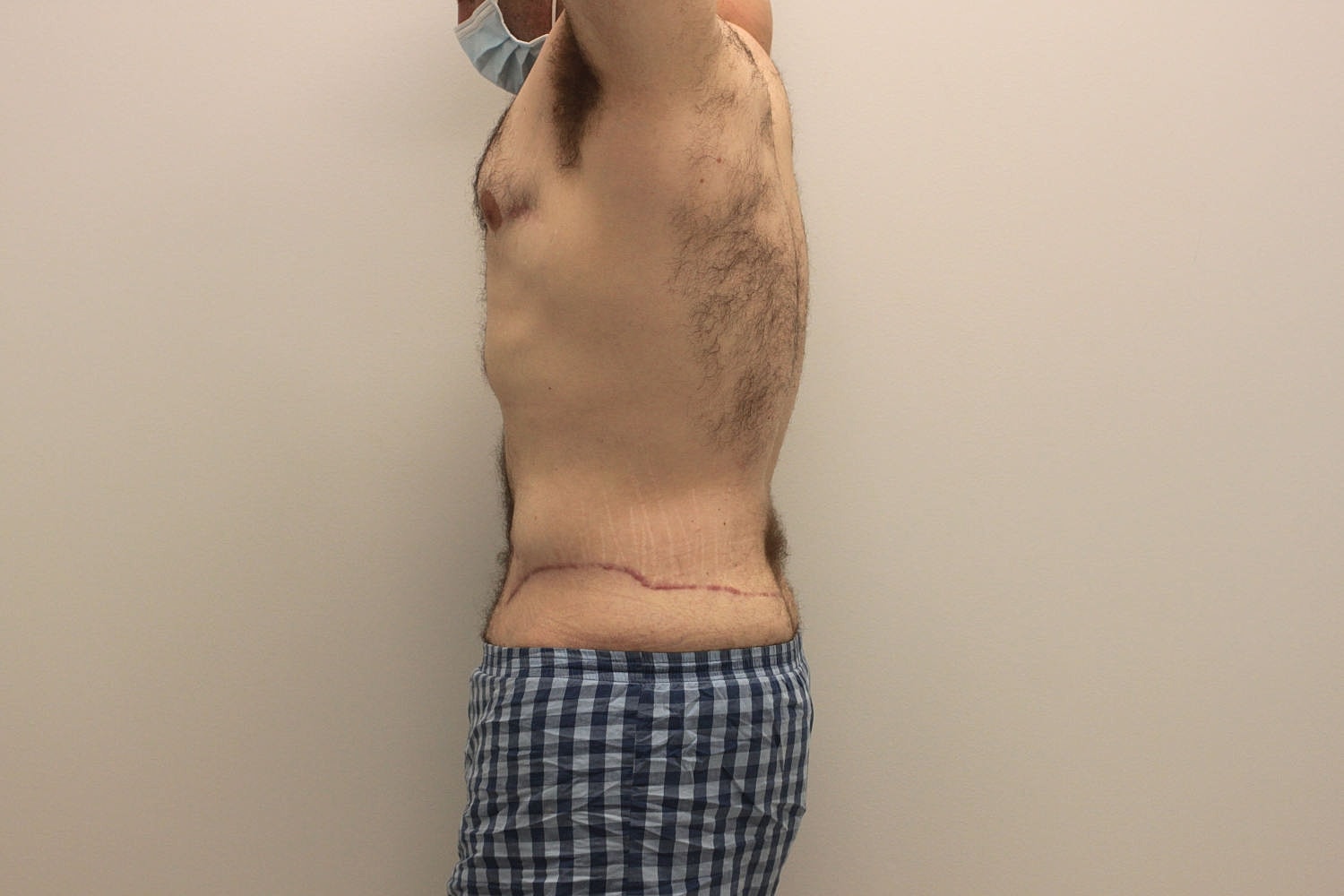 Male Body Contouring Before & After