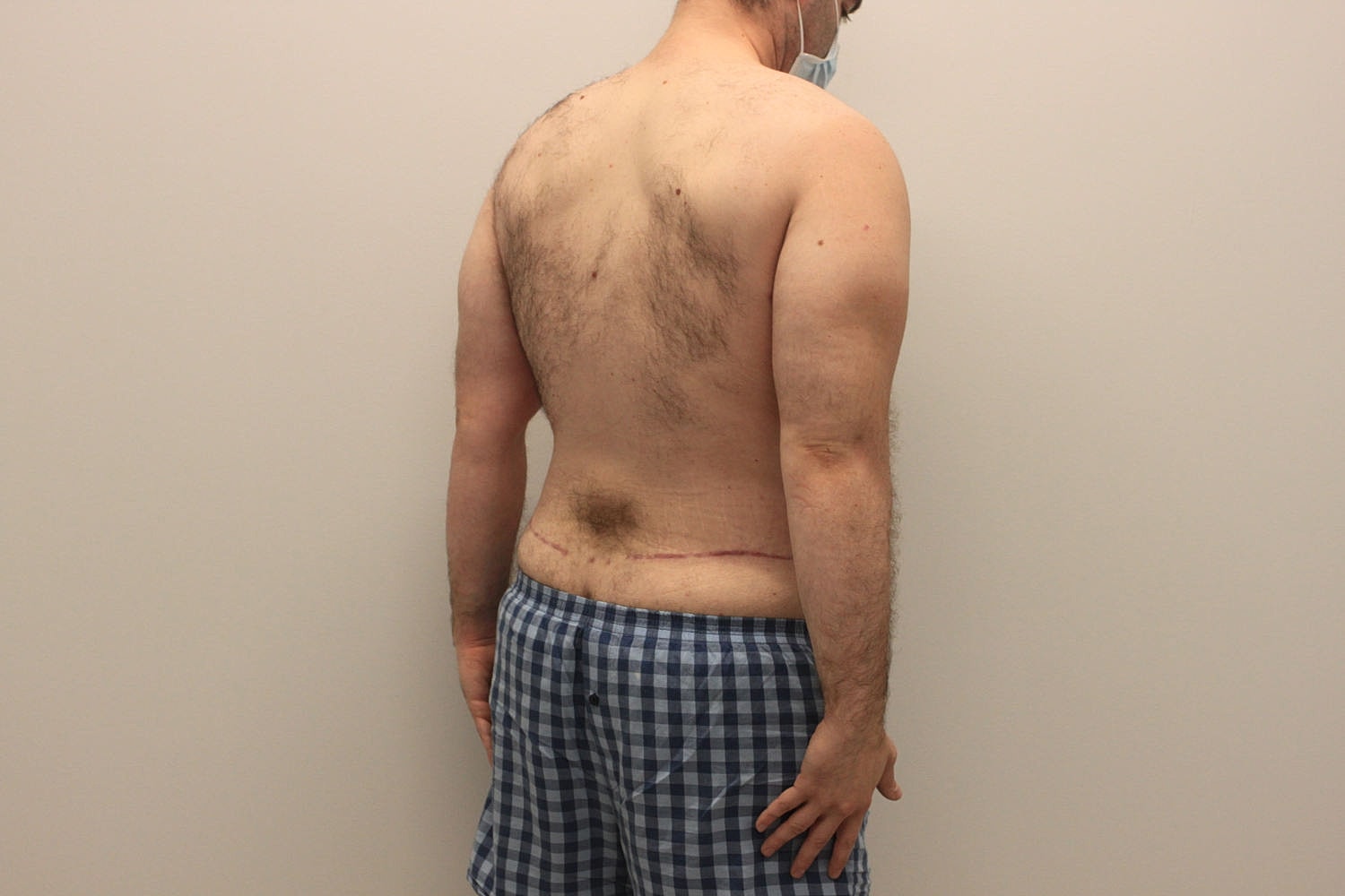 Male Body Contouring Before & After