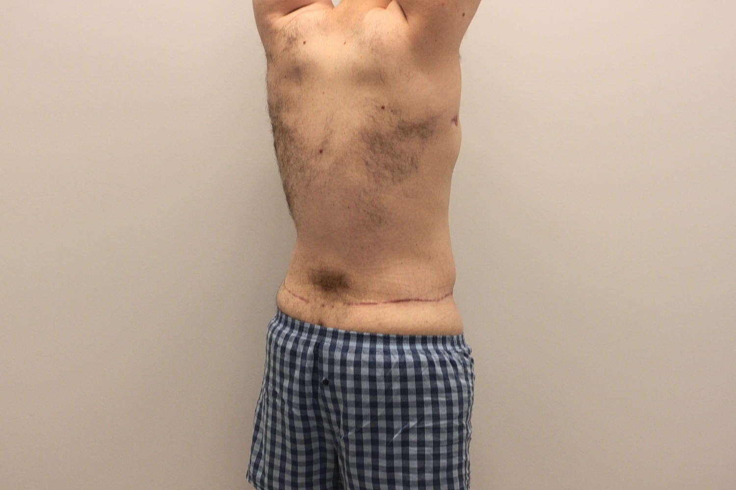 Male Body Contouring Before & After