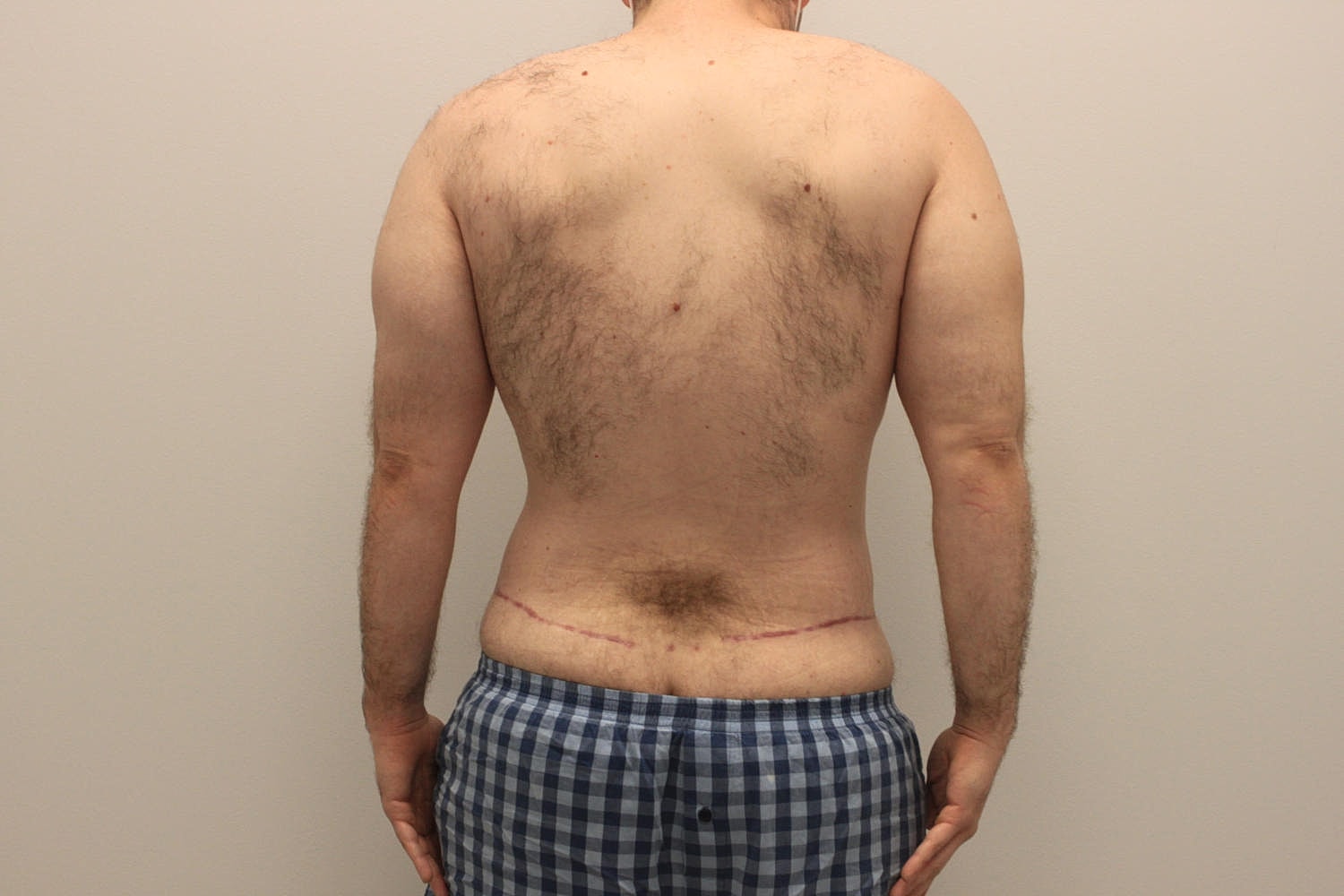 Male Body Contouring Before & After