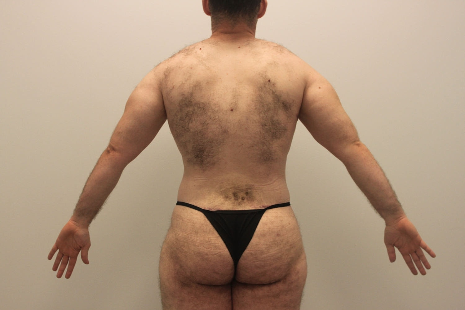 Male Body Contouring Before & After