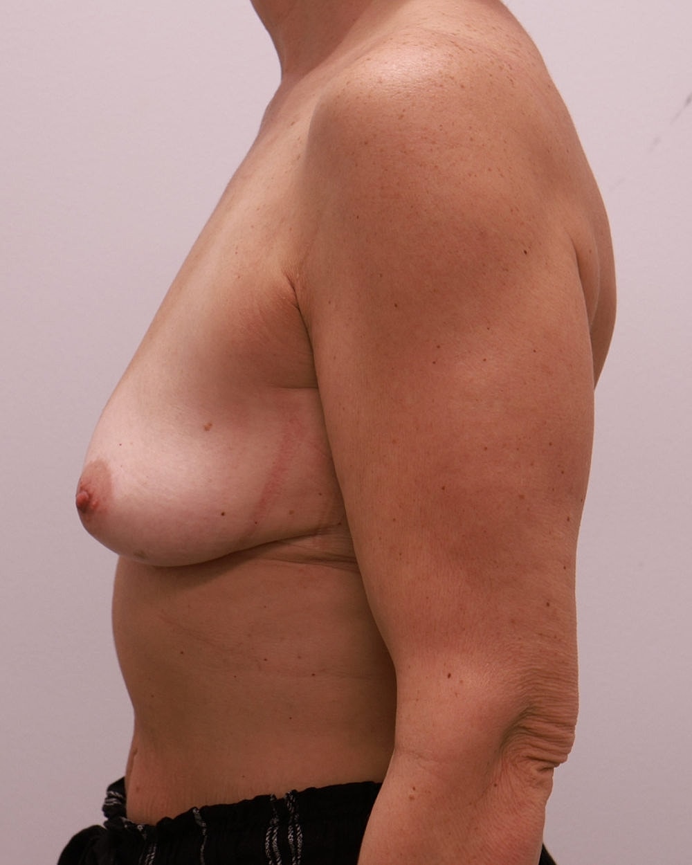 Breast Augmentation Before & After