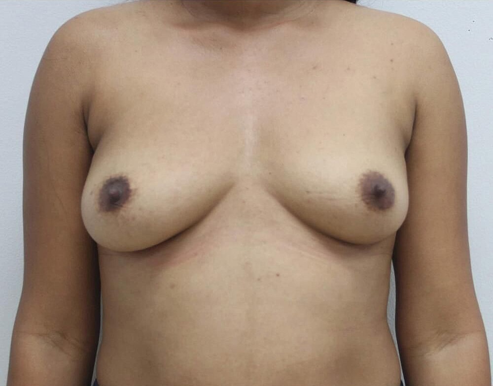 Breast Augmentation Before and After Photos before-after 1