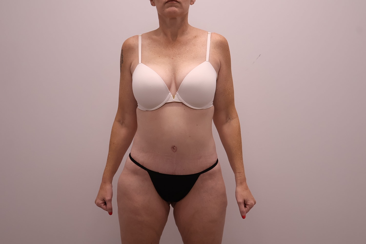 Circumferential Body Lift Before & After