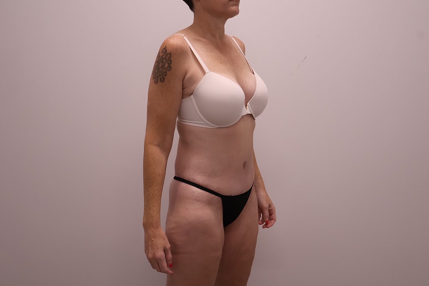 Circumferential Body Lift Before & After