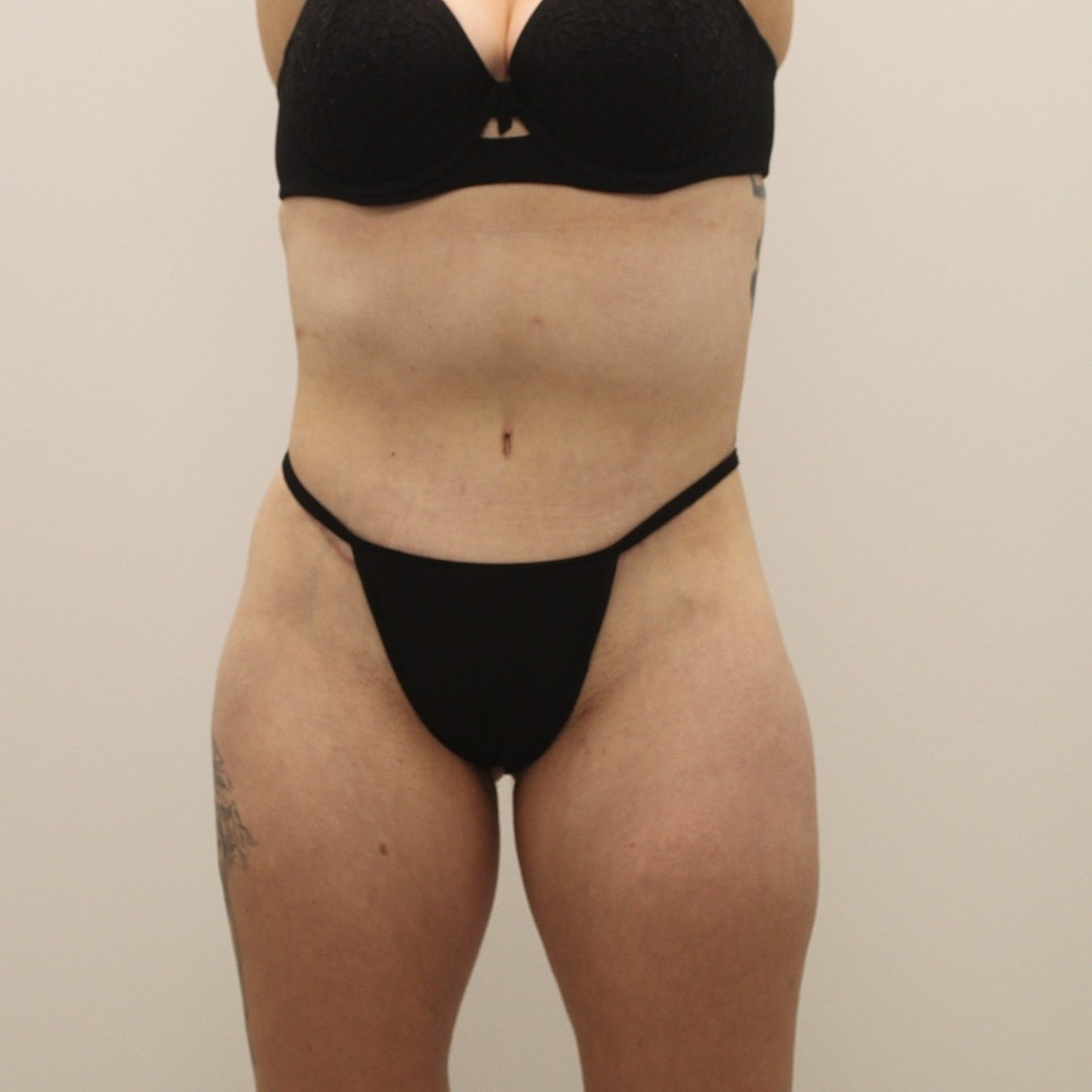 Circumferential Body Lift Before & After