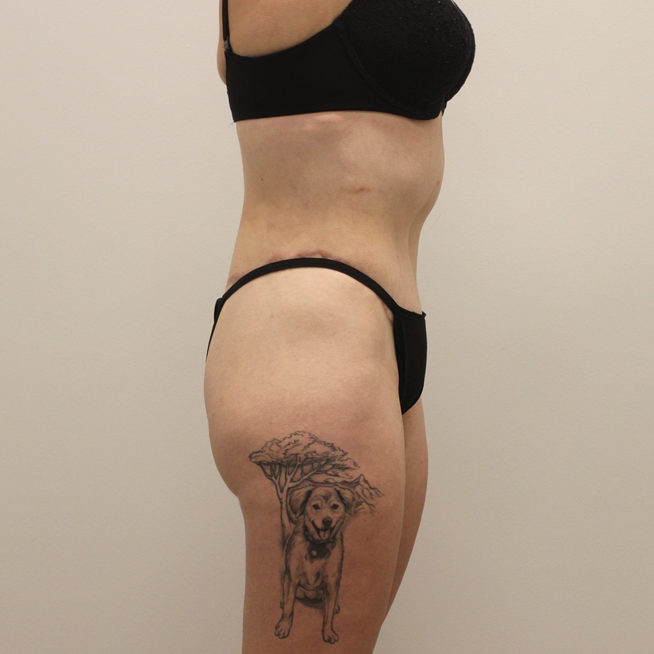 Circumferential Body Lift Before & After