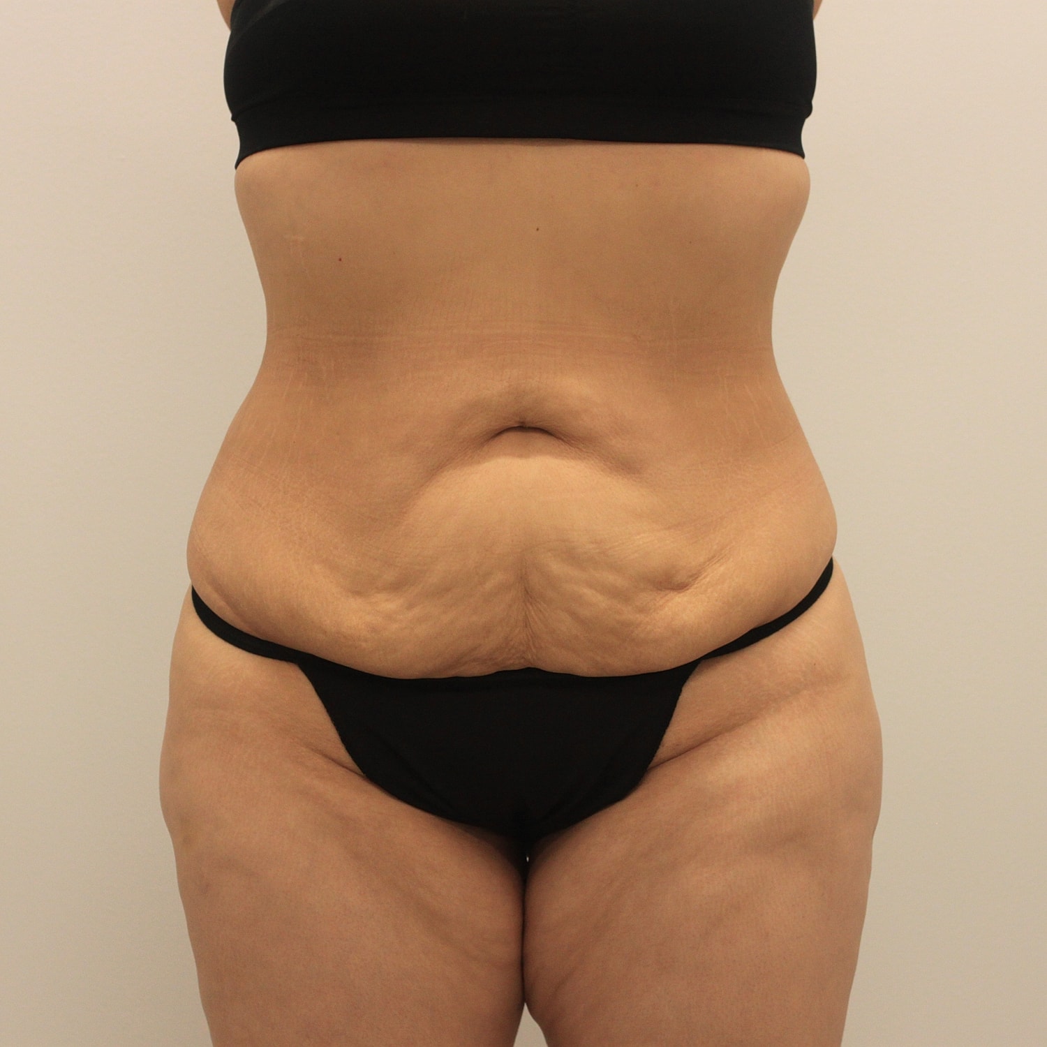 Circumferential Body Lift Before & After