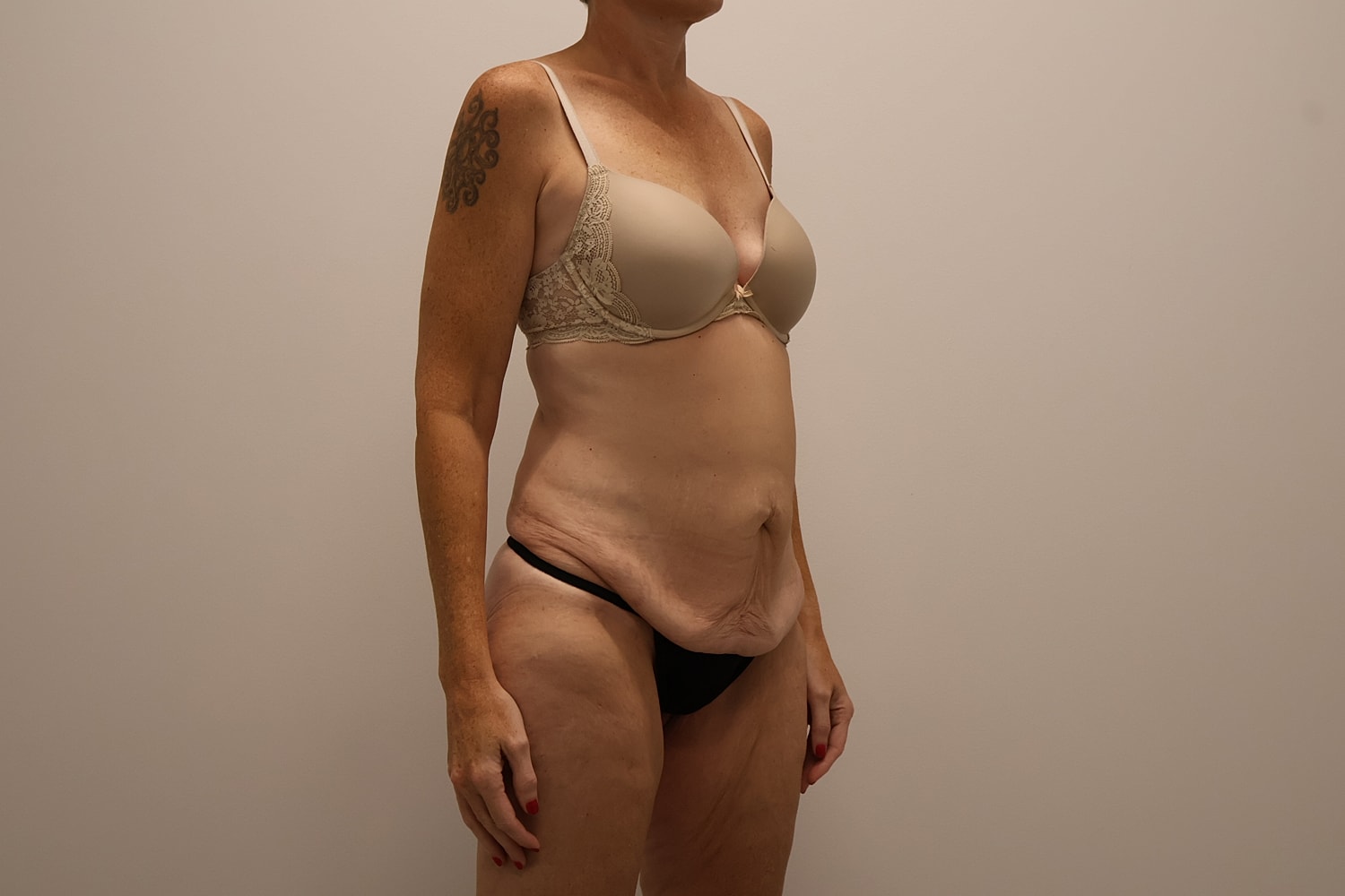 Circumferential Body Lift Before & After