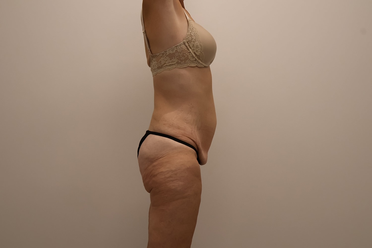 Circumferential Body Lift Before & After