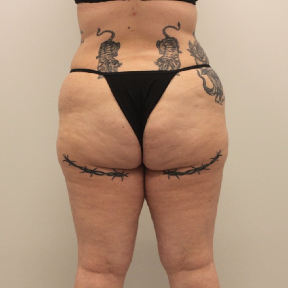 Sculptra Buttock Augmentation Before & After