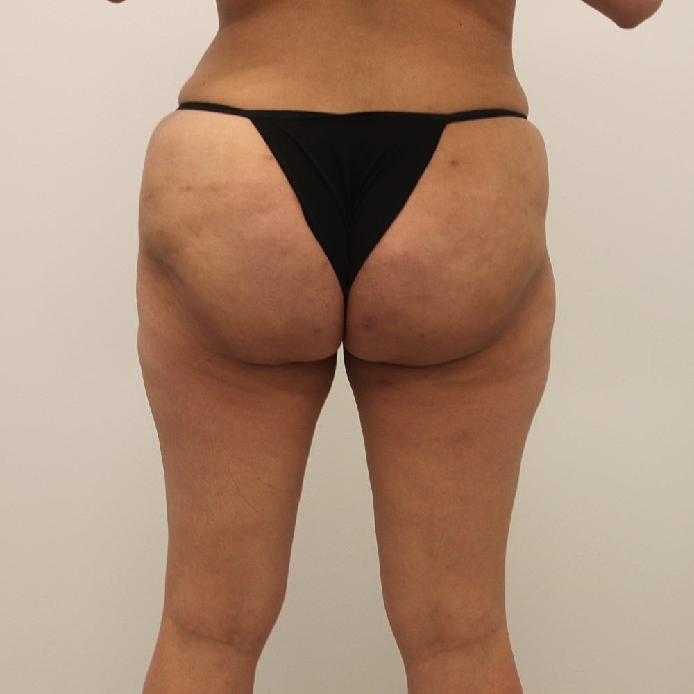Sculptra Buttock Augmentation Before & After