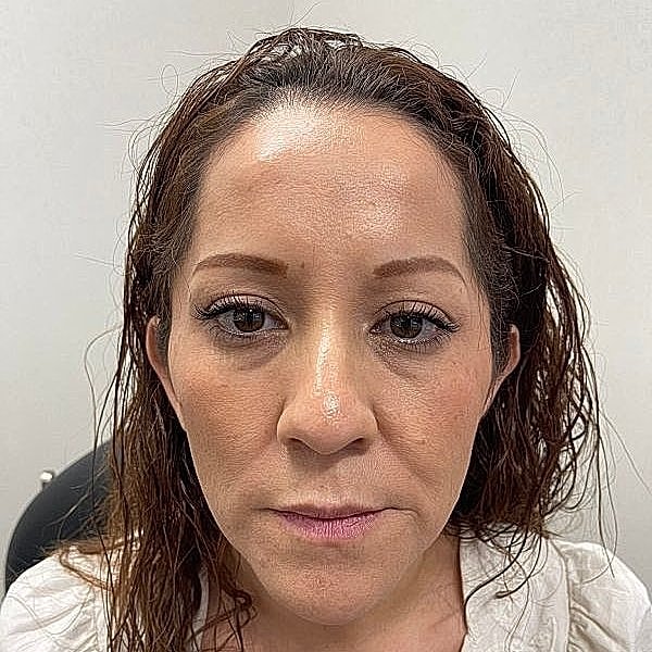 Dermal Filler Before & After