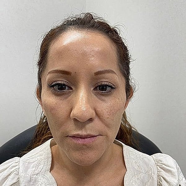 Dermal Filler Before & After