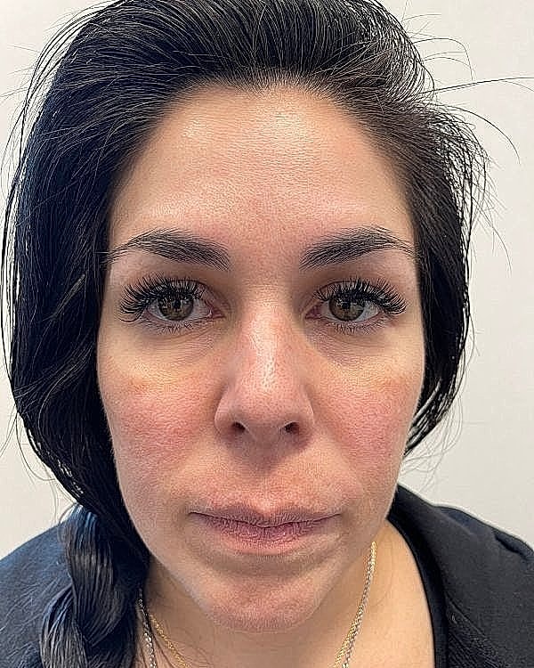 Dermal Filler Before & After