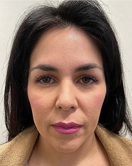 Dermal Filler Before & After