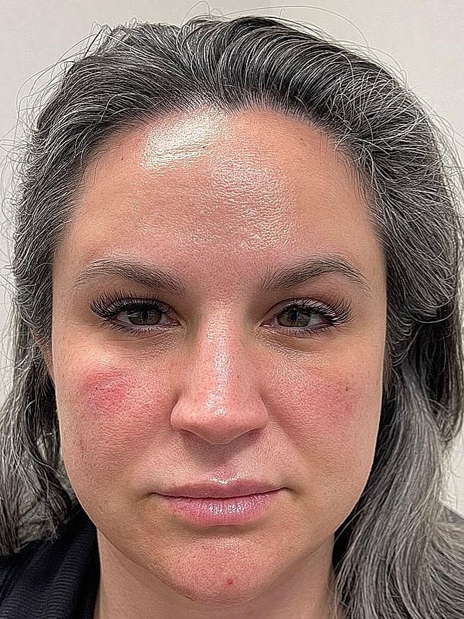 Dermal Filler Before & After