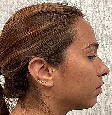 Dermal Filler Before & After