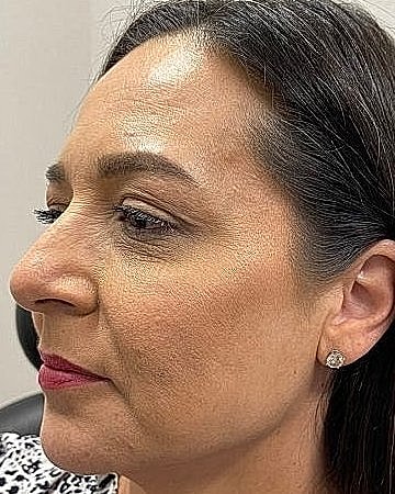 Dermal Filler Before & After