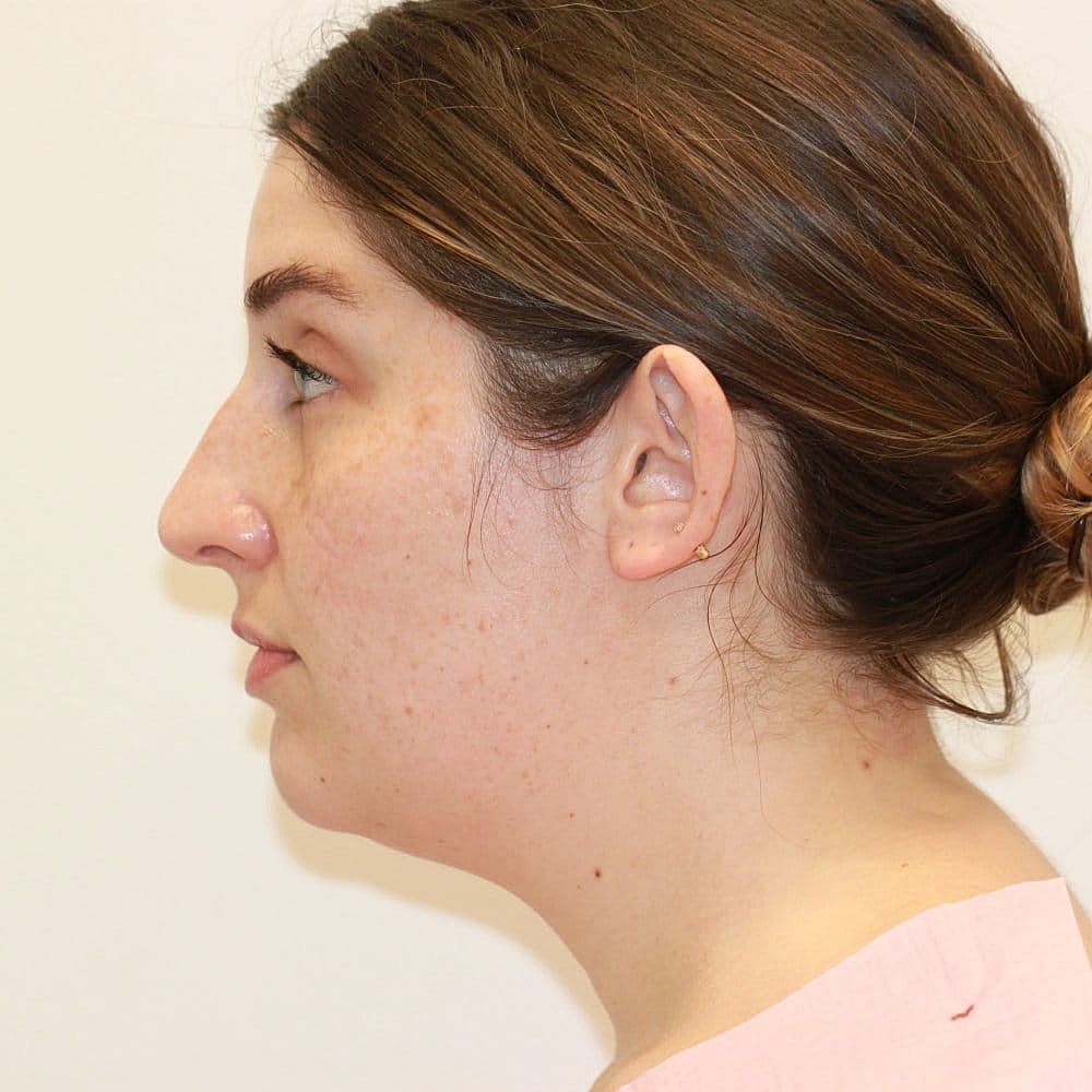 Kybella Before & After