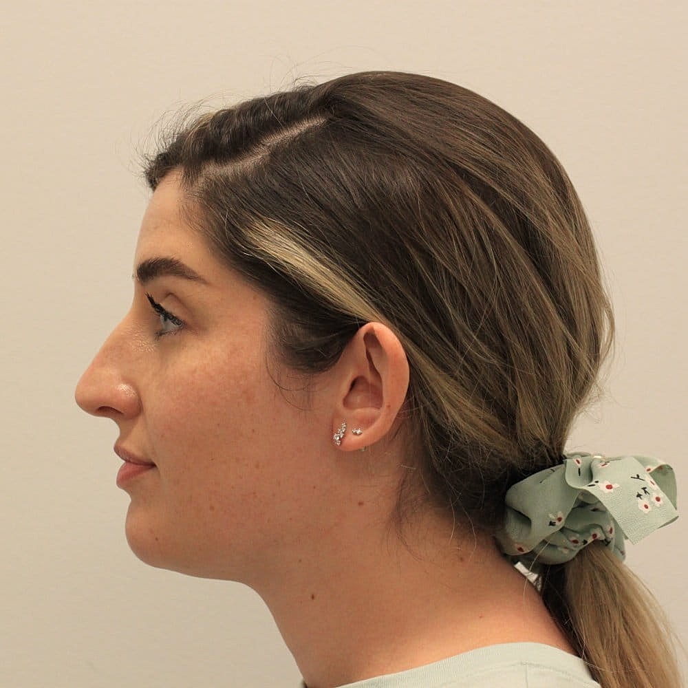 Kybella Before & After