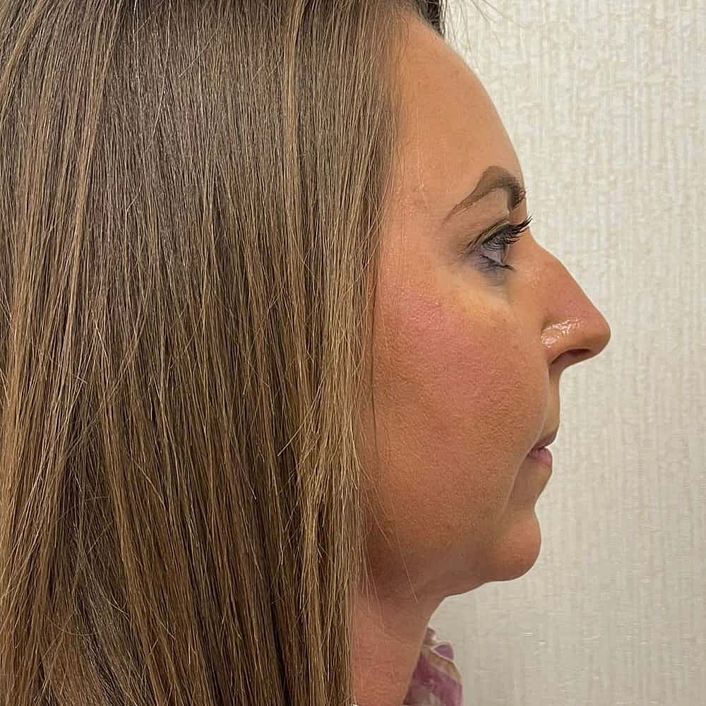 Kybella Before & After