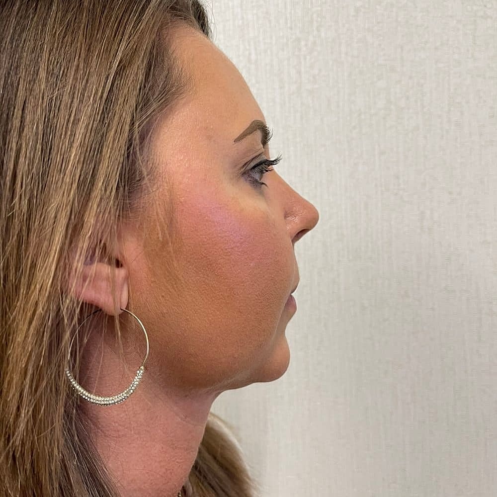 Kybella Before & After