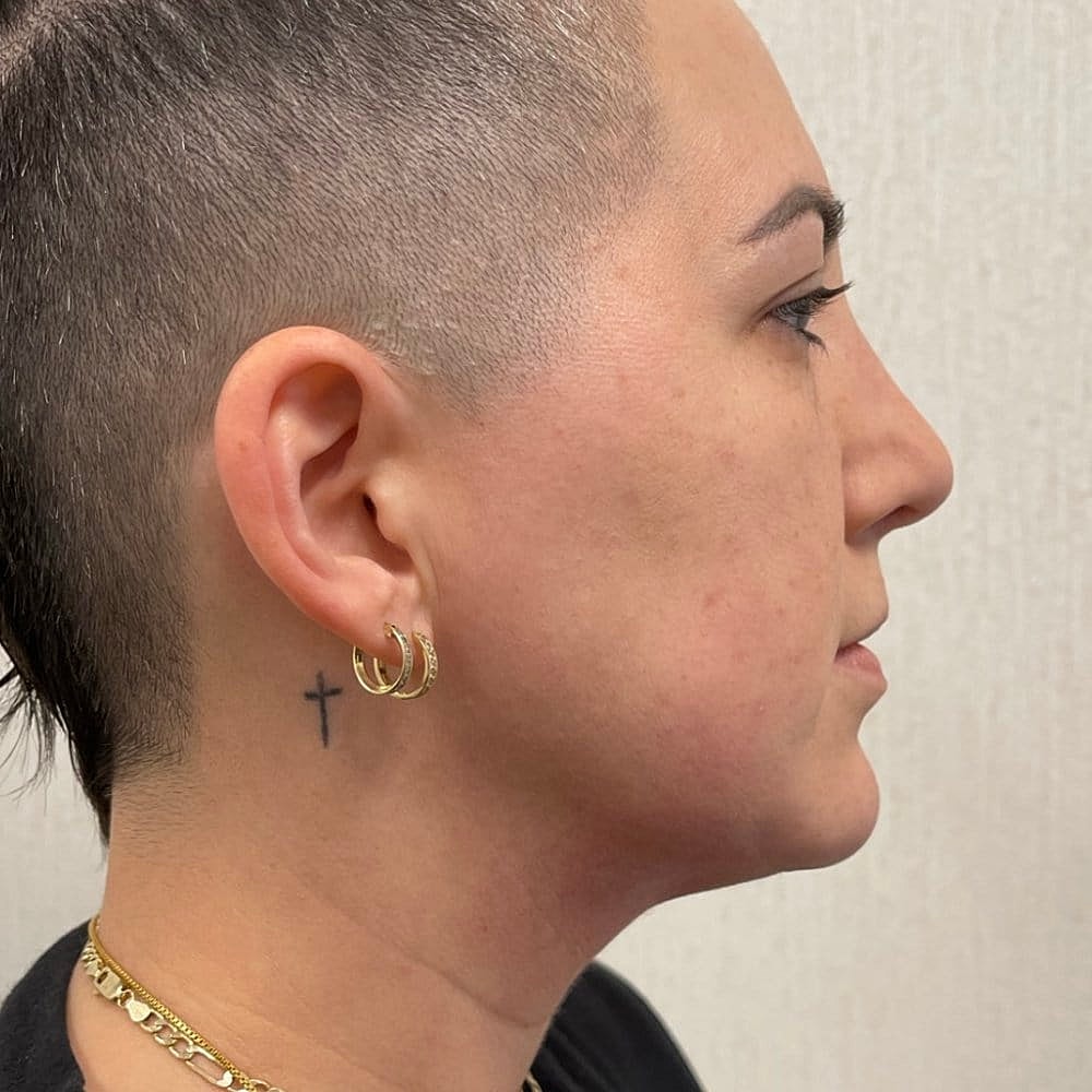 Kybella Before & After