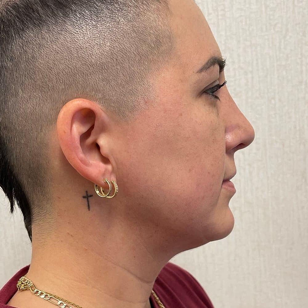 Kybella Before & After