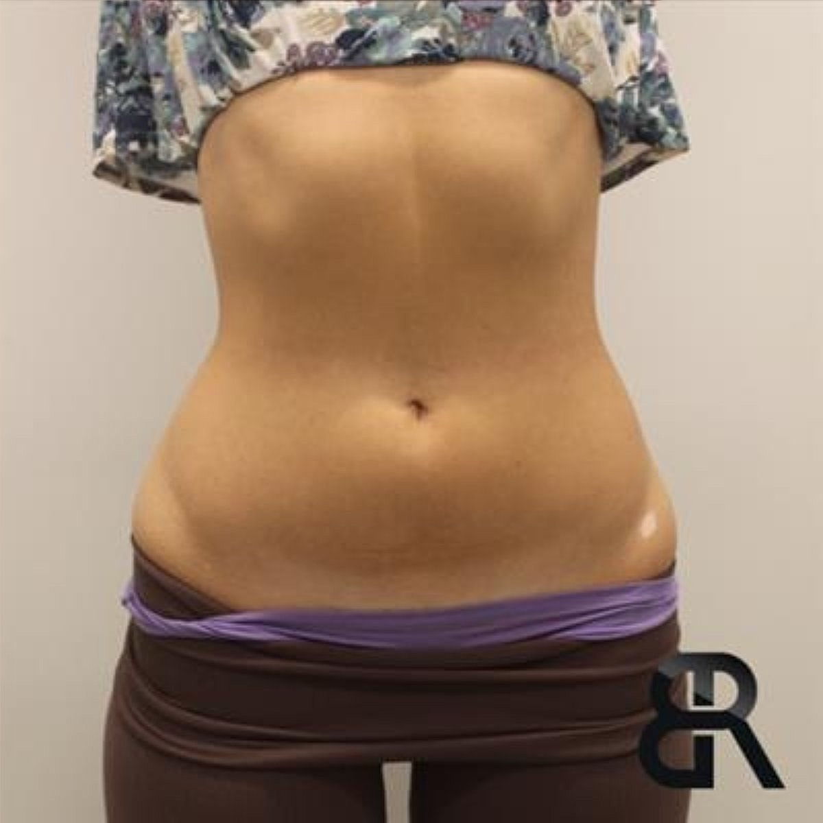 Evolve Before & After