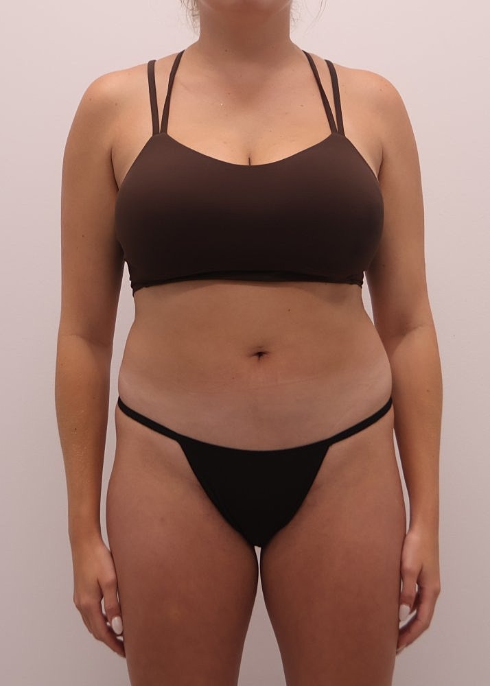 MEDICAL WEIGHT LOSS PROGRAM Before & After